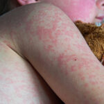 Measles outbreak erupts in one of Texas’ least vaccinated counties